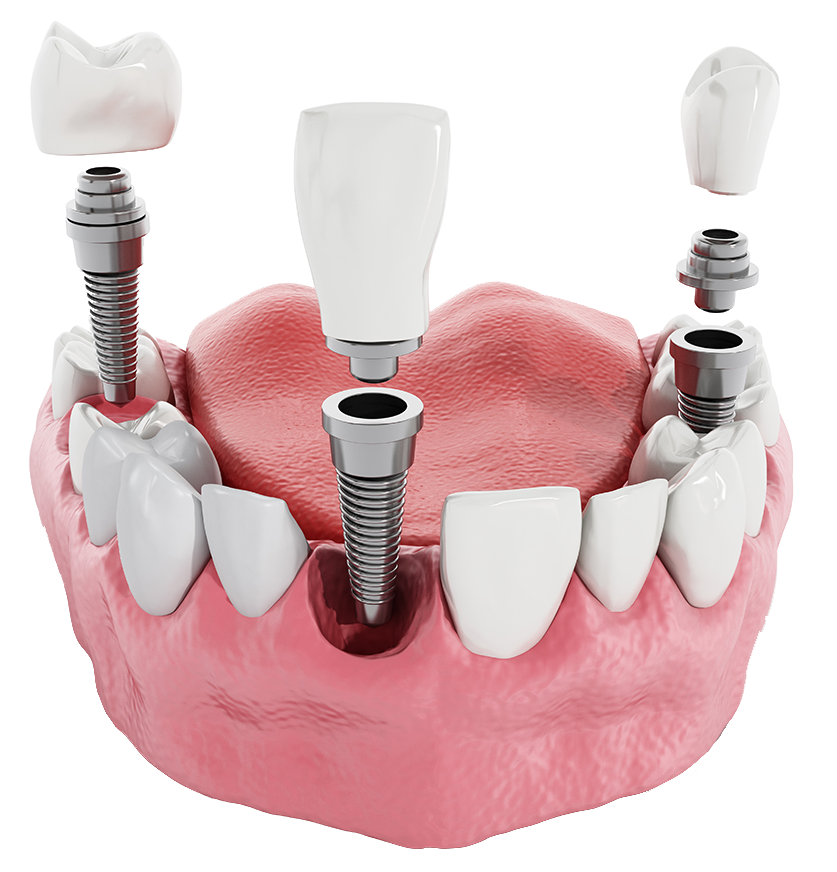 Implantes y cirugía oral