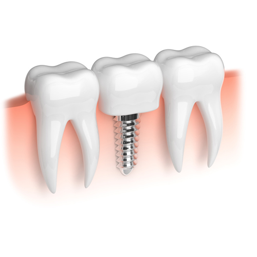 Implants dental fixes
