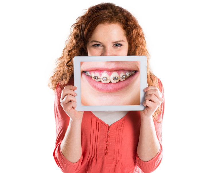 Ventajas y desventajas de la ortodoncia tradicional