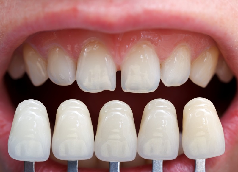 Cuánto duran las carillas dentales y cuándo cambiarlas