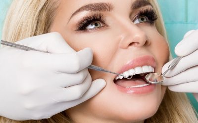 ¿Cuánto duran las carillas dentales?