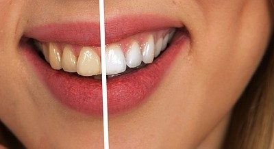 Fluorosis dental cómo evitar este tipo de manchas en los dientes.